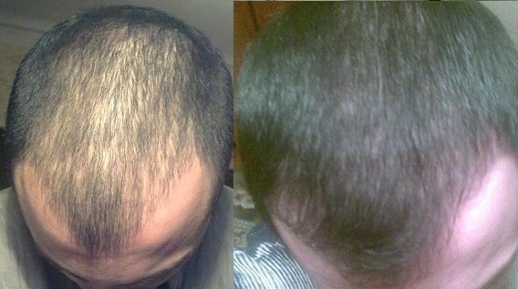 Андрогенная алопеция: фото до и после пересадки волос
