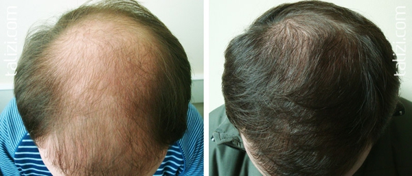 Фото пациента с алопецией (до и после пересадки волос)