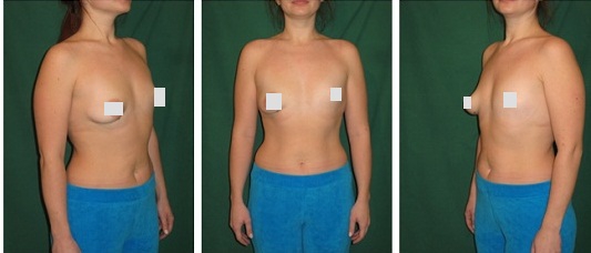 Асимметрия молочных желез: груди разного размера