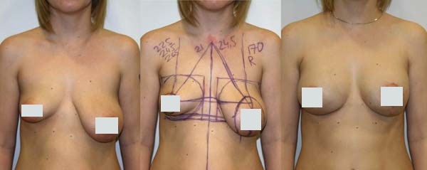 Асимметрия груди операция