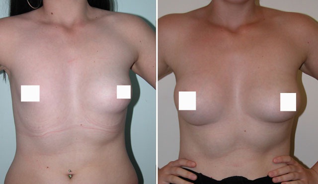 Фото до и после операции по устранению асимметрии груди