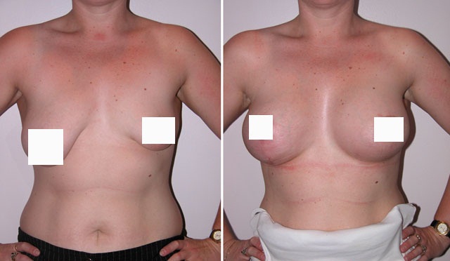 Фото до и после коррекции асимметрии груди