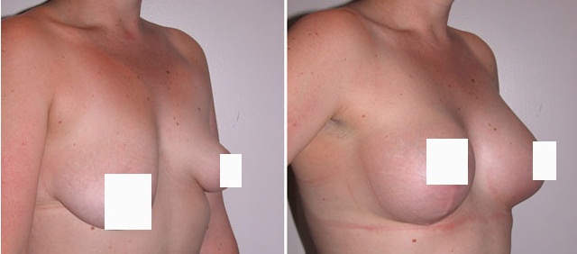 Асимметричная грудь - фото до и после коррекции