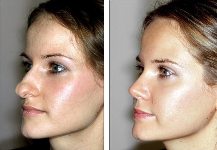 Кончик носа большой: фото до и после операции