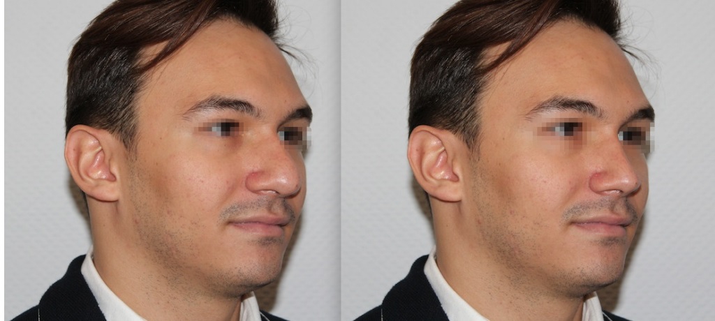 У мужчины большой нос: фото до и после