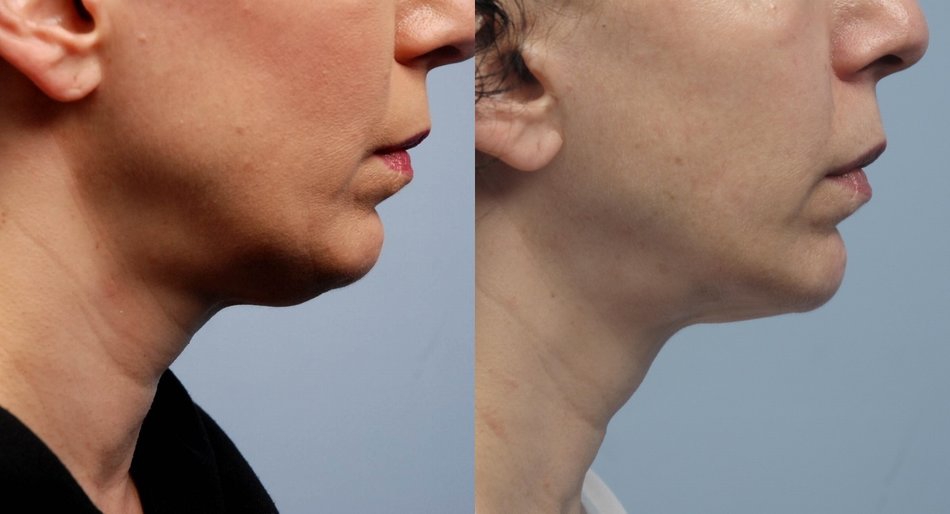 Фото пациентов до и после подтяжки брылей