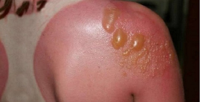 Кожный дерматит: пузыри – главные симптомы буллёзной формы заболевания