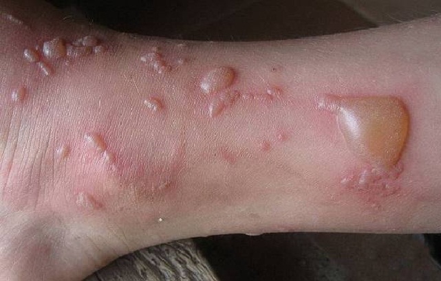 Буллёзный кожный дерматит