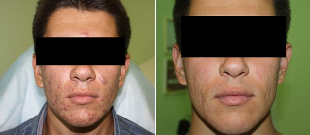 Демодекоз у человека: фото до и после лечения