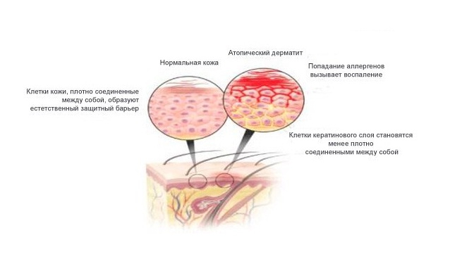 Развитие дерматита (схема)