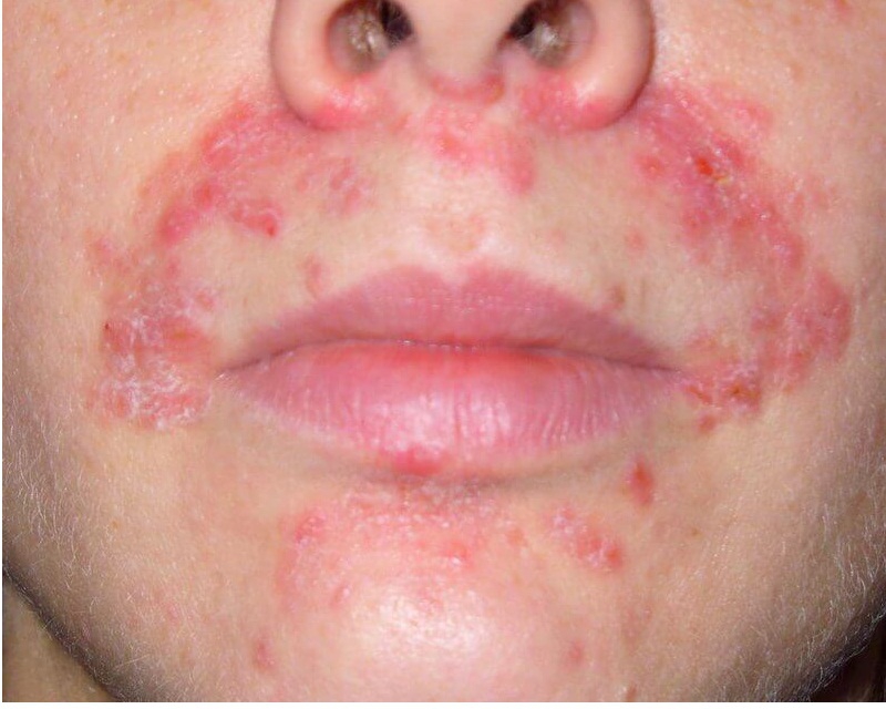 Дерматит на губах (периоральный дерматит)