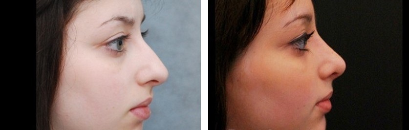 Девушка с длинным носом до и после ринопластики