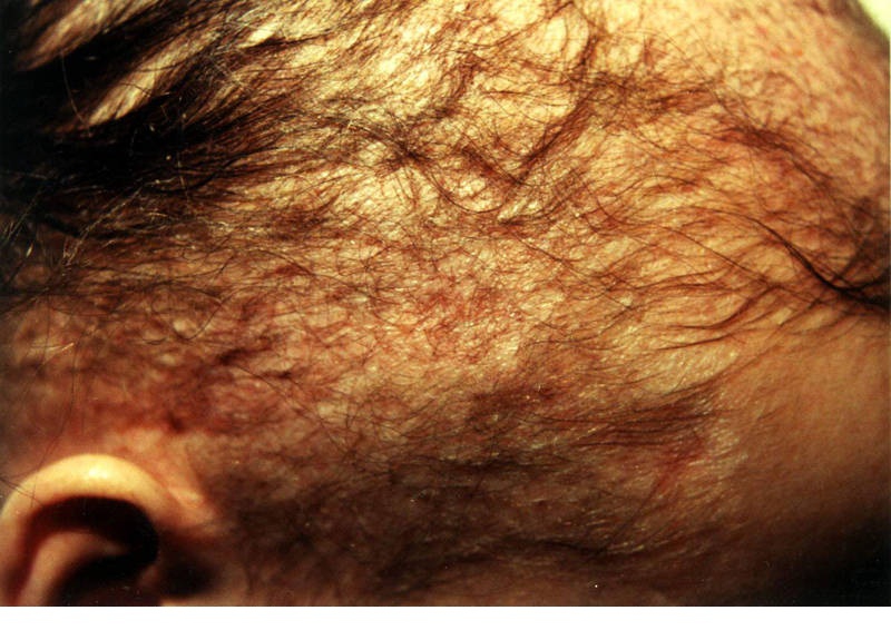 Монилетрикс – наследственная форма гиперкератоза, затрагивающая кожу и волосы