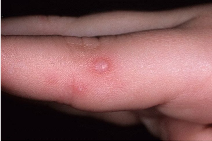 Герпетический дерматит – везикулы на пальцах рук
