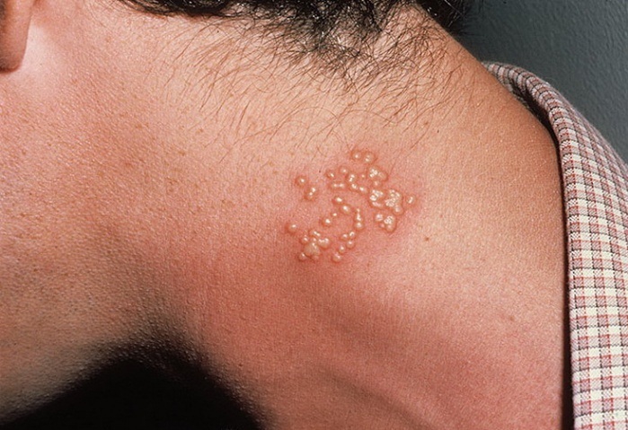Герпетический дерматит – везикулы на шее