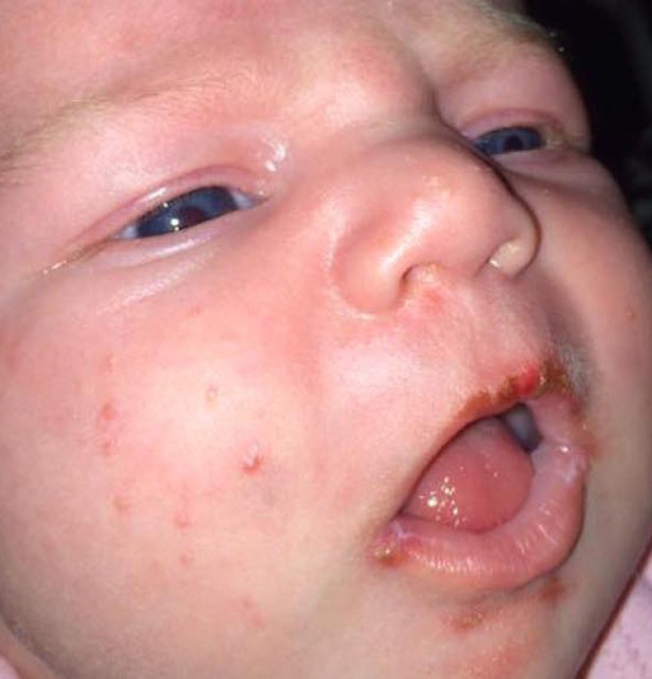 Герпетический дерматит у ребенка