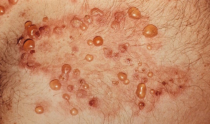 Симптомом герпетиформного дерматита являются везикулы – мелкие пузырьки с жидкостью