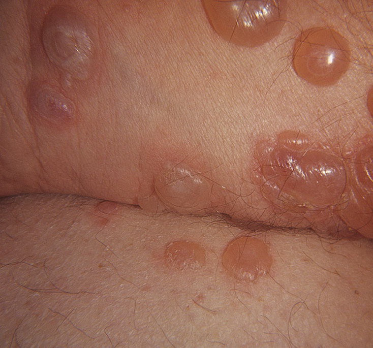 Симптомом герпетиформного дерматита являются буллы – крупные (до двух сантиметров в диаметре) пузыри с жидкостью
