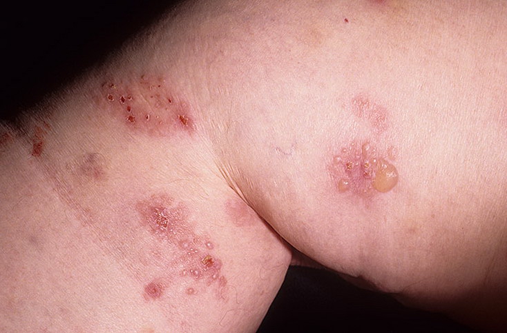 Герпетиформный дерматит – это хроническое заболевание кожных покровов