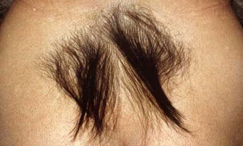 Избыточный рост волос на пояснице  (гипертрихоз)