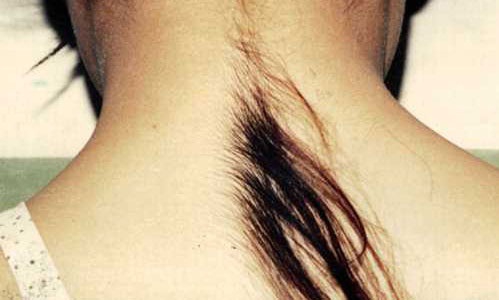 Избыточный рост волос на шее (гипертрихоз)