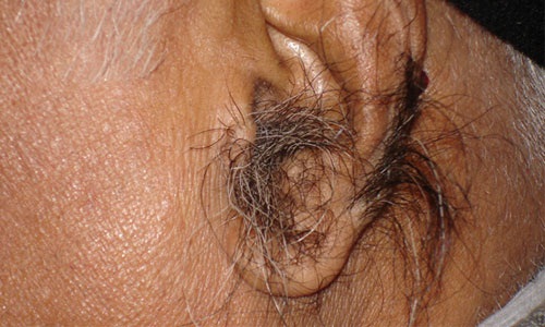 Избыточный рост волос в ушах  (гипертрихоз)