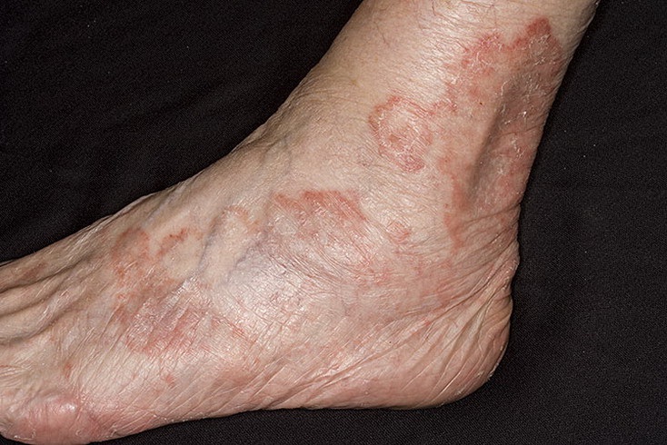 Так выглядит кожа ног, пораженная грибком