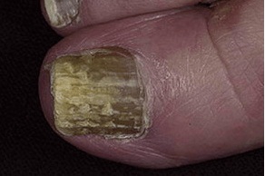 Плесневый грибок ногтей
