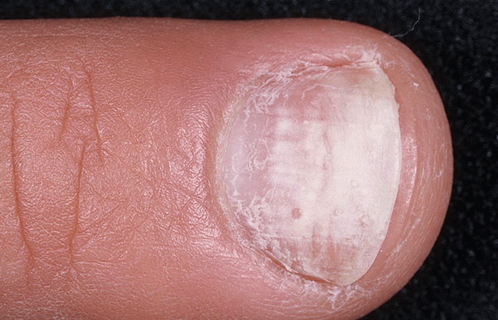 Вторая стадия поражения ногтей грибком