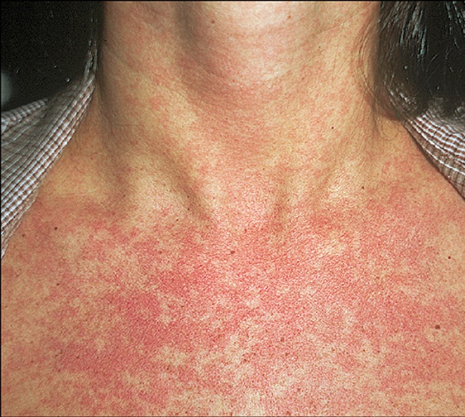 Инфекционный дерматит: высыпания при краснухе