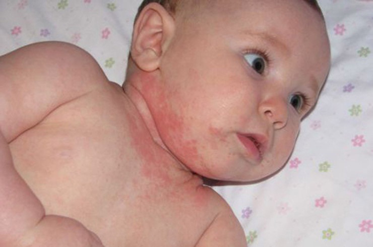 Опрелости (интертригинозный дерматит) у ребенка