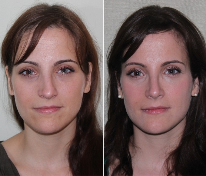 Искривление носовой перегородки: фото пациентки до и после операции