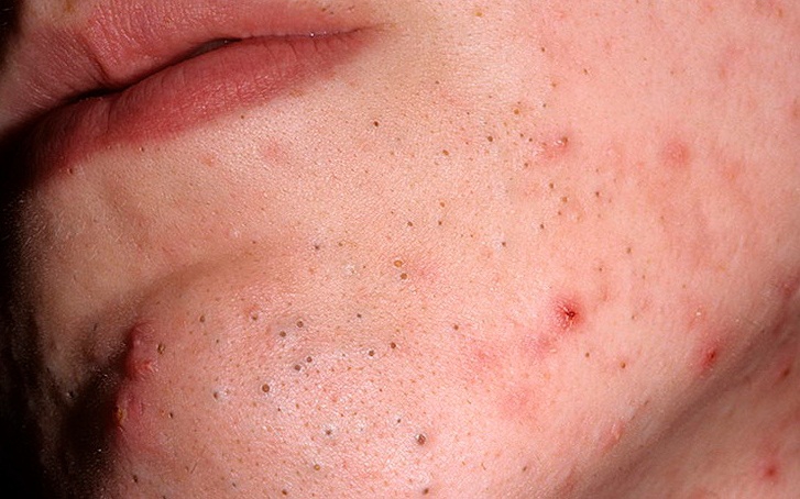 Комедоны кожи лица симптомы thumbnail