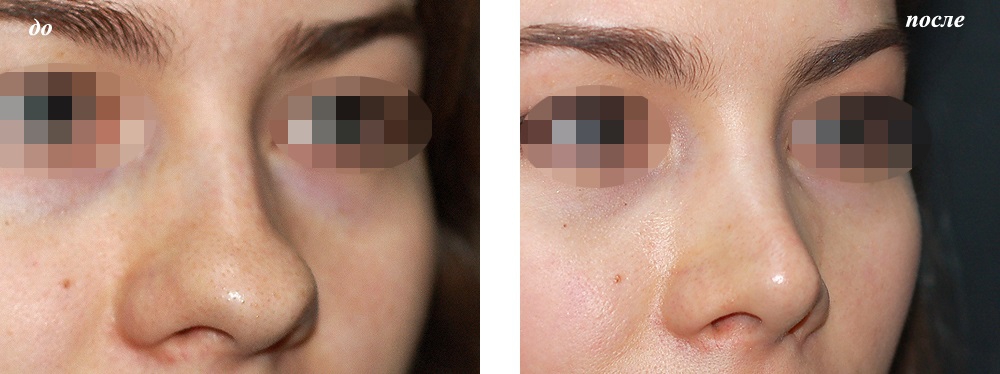 Коррекция кончика носа: фото до и после операции
