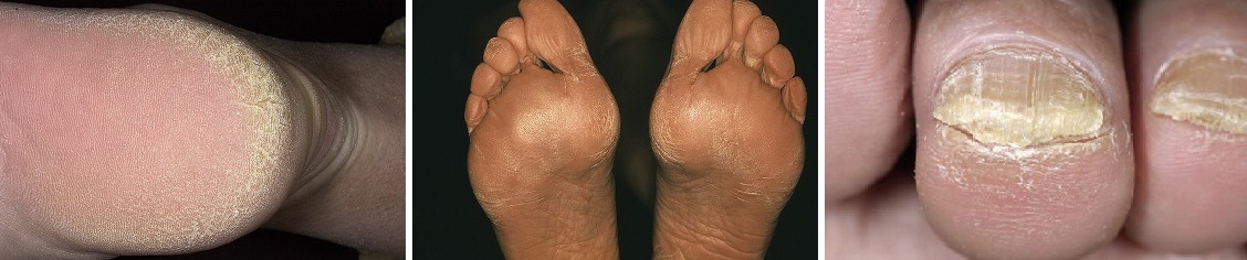 Гиперкератоз ступней ног