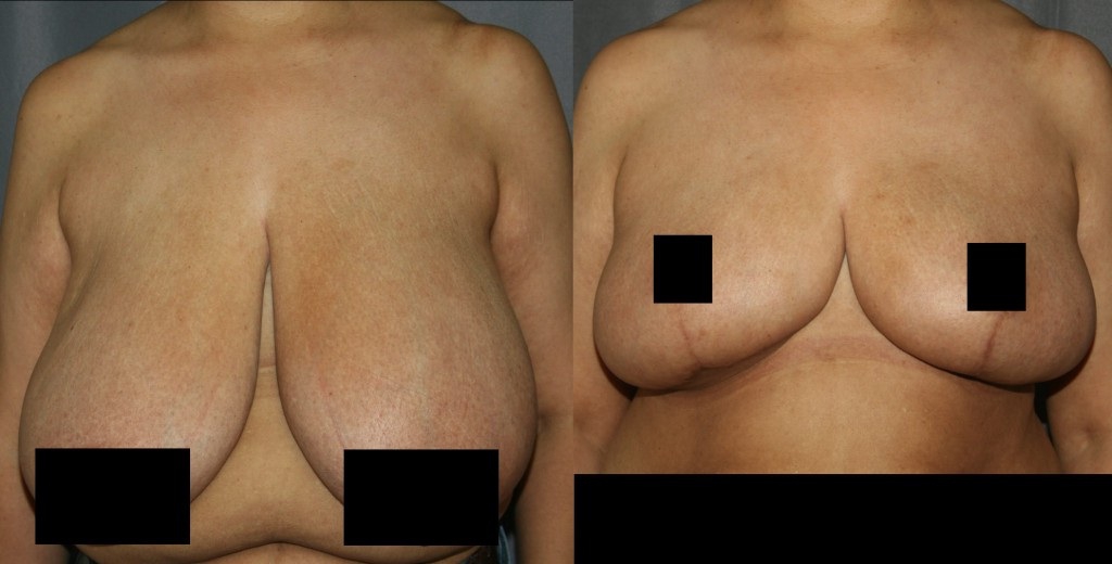 Макромастия – фото до и после операции