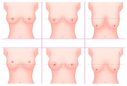 Результат коррекции молочных желез в зависимости от стадии мастоптоза