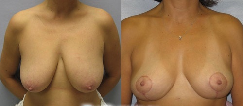 Мастоптоз: фото до и после коррекции отвисшей груди