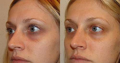 Фото пациентов до и после коррекции мешков под глазами