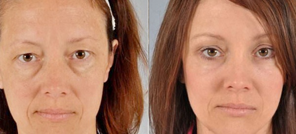 Фото пациентов до и после коррекции мешков под глазами
