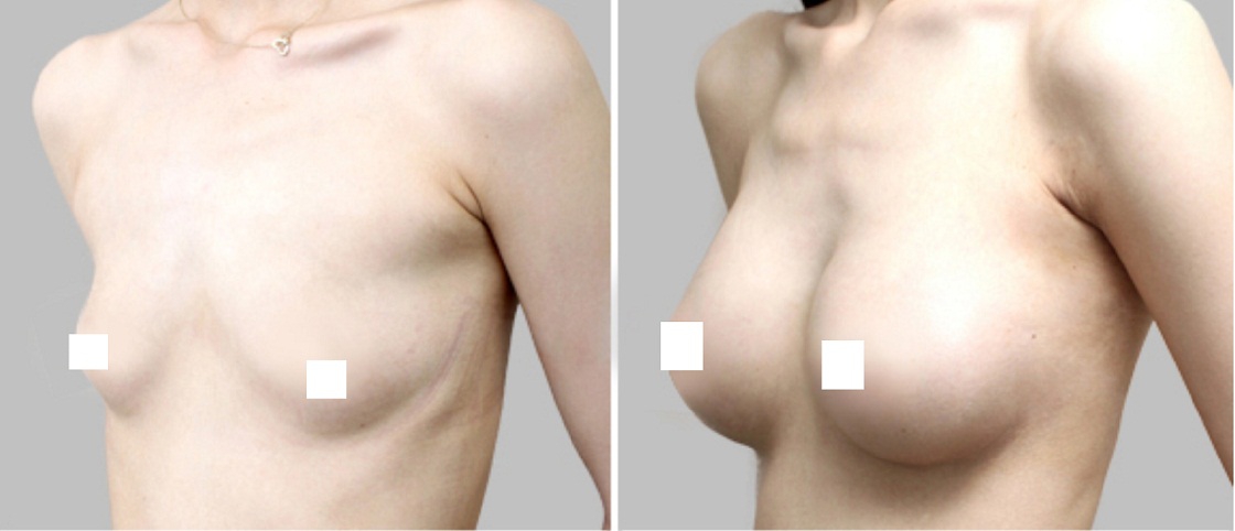 Фото до и после хирургического лечения микромастии