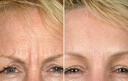 Фото пациентов до и после коррекции морщин между бровями