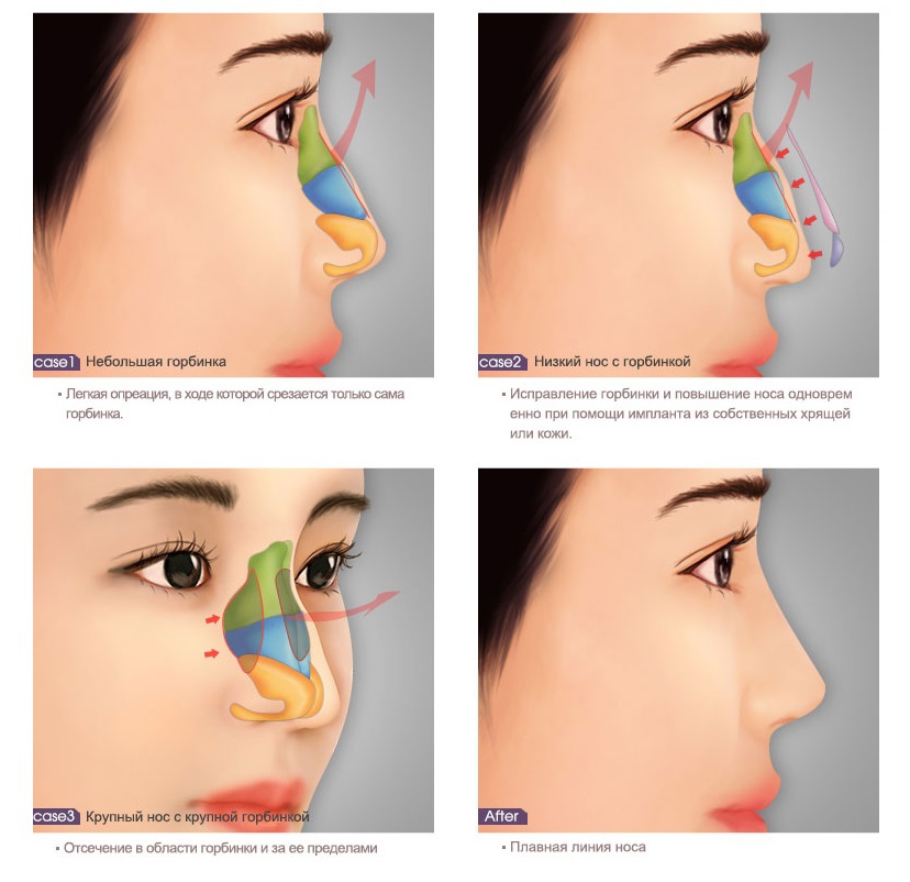 Как хирург исправляет горбинку на носу