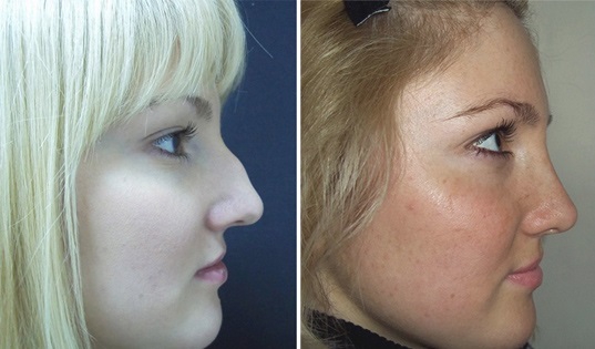 Горбинка на носу у девушки: фото до и после операции