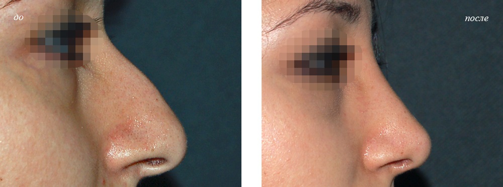 Горбинка на носу: девушка до и после коррекции