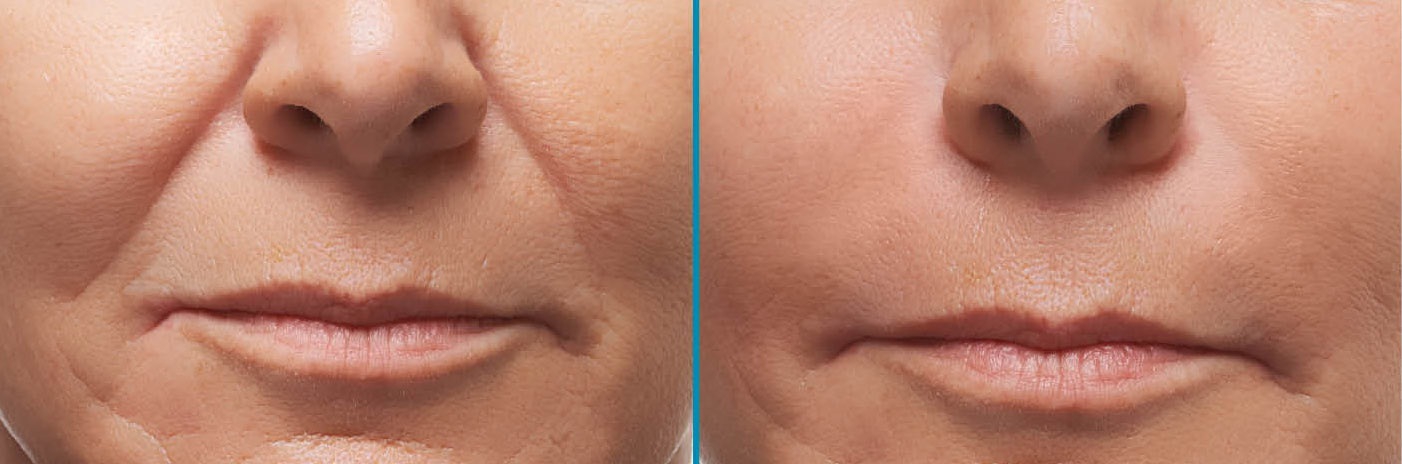 Носогубные морщины: фото до и после коррекции