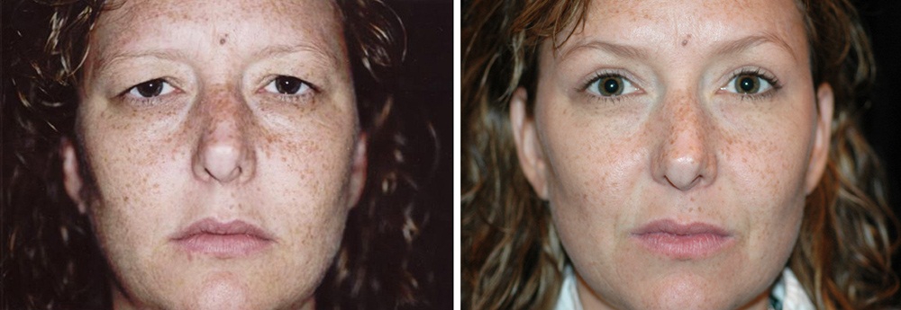 Фото до и после коррекции опущения бровей