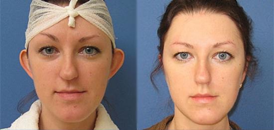 Фото до и после оперативного лечения лопоухости