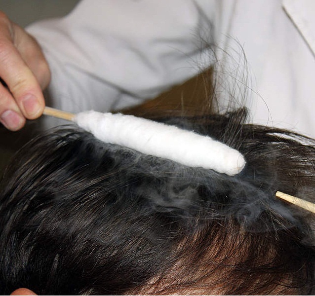Лечение кожи головы от перхоти (криомассаж)