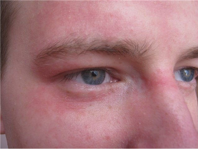 Периоральный дерматит локализуется не только вокруг рта – высыпания обнаруживаются и в зоне вокруг глаз